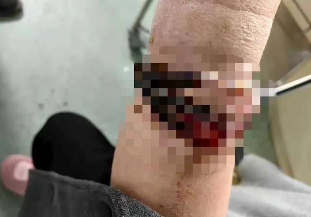 登1信用盘代理
_女子手镯10年没摘竟“长”进肉里登1信用盘代理
！医生：再晚点就保不住了