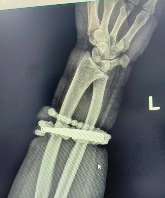 登1信用盘代理
_女子手镯10年没摘竟“长”进肉里登1信用盘代理
！医生：再晚点就保不住了