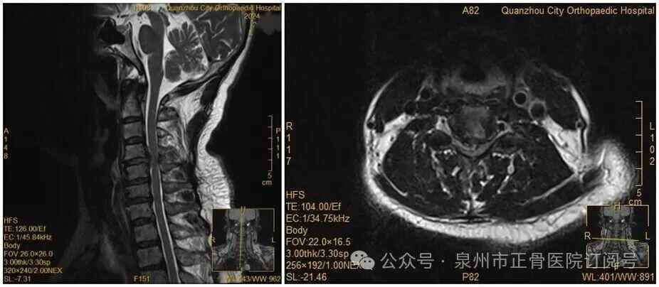罗瑟汉姆 vs 保顿艾尔宾
_女子因手麻到医院就诊罗瑟汉姆 vs 保顿艾尔宾
，拒绝医生颈椎手术建议，当晚翻身竟导致瘫痪，医生提醒→